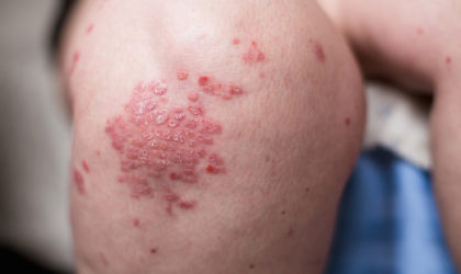 psoriasis