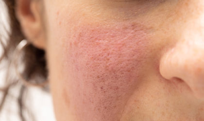 Rosacea