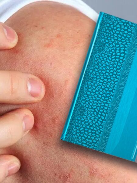 Libro Dermatitis Atópica