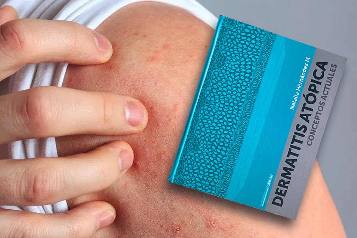 Libro Dermatitis Atópica