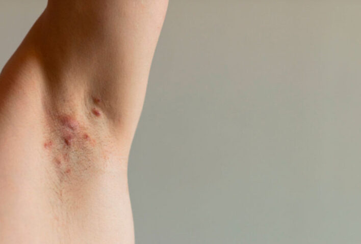 Hidradenitis Supurativa