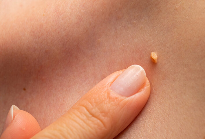 Acrocordones en el cuello